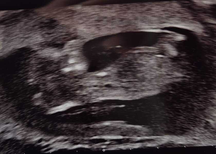 12 week scan - issues and nub?!
