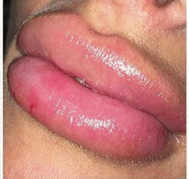 To wonder what’s going on with all the big lips