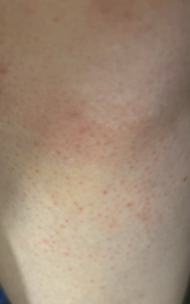 Does this look like shingles?