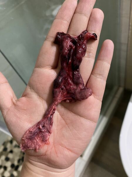 Does this miscarriage tissue look normal?