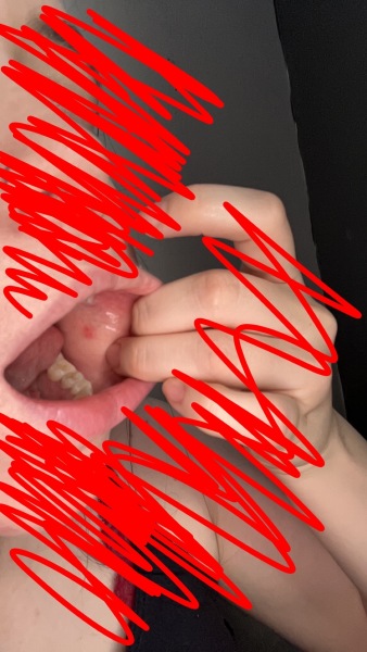 Hair loss 10 months after baby