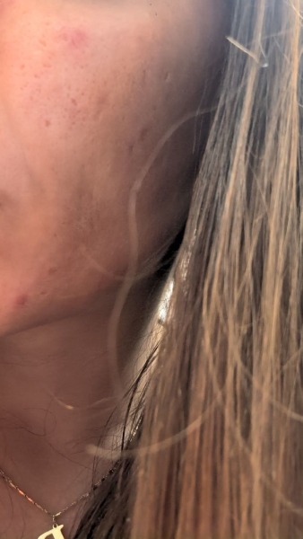 Bad skin at 30