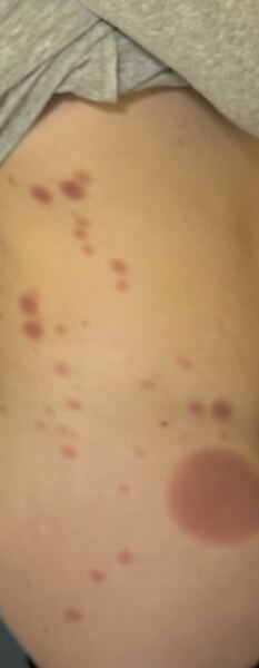 Can anyone help - is this pityriasis rosea??