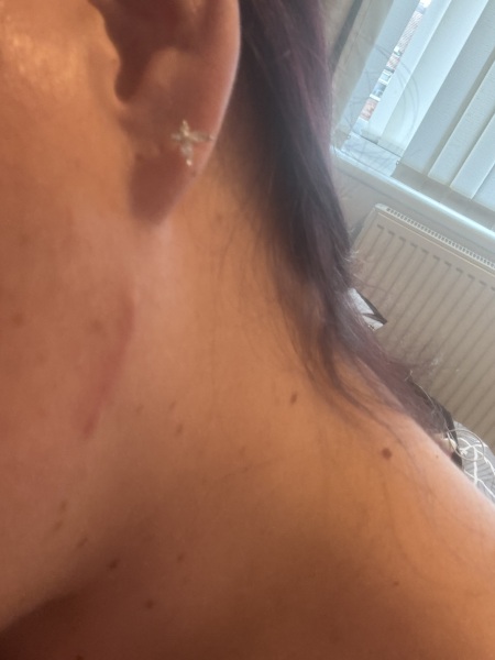 Cancer scare? Mole cut off , pain?