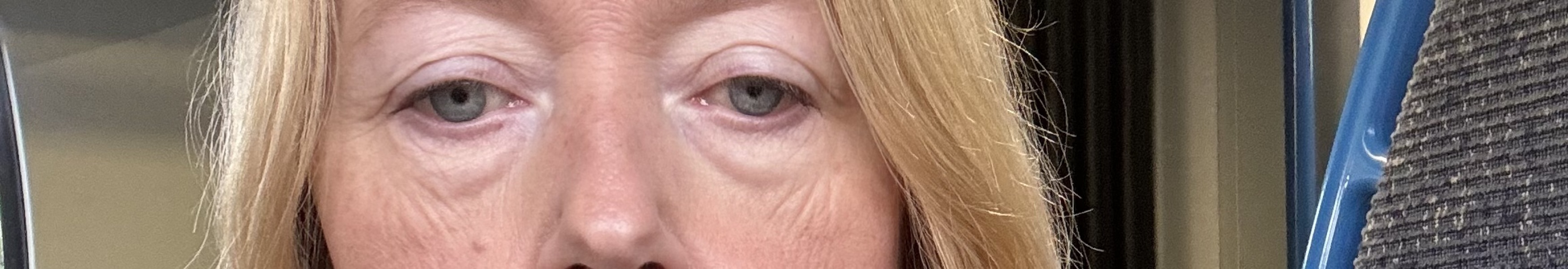 Terrible lines/bags under eyes