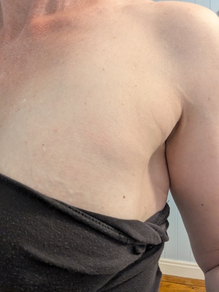 Lump