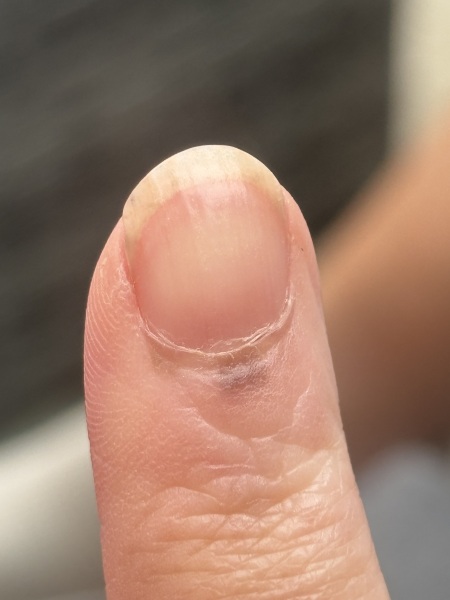 Dark mark beneath cuticle