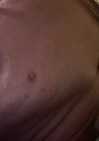 Should I get this mole checked out?