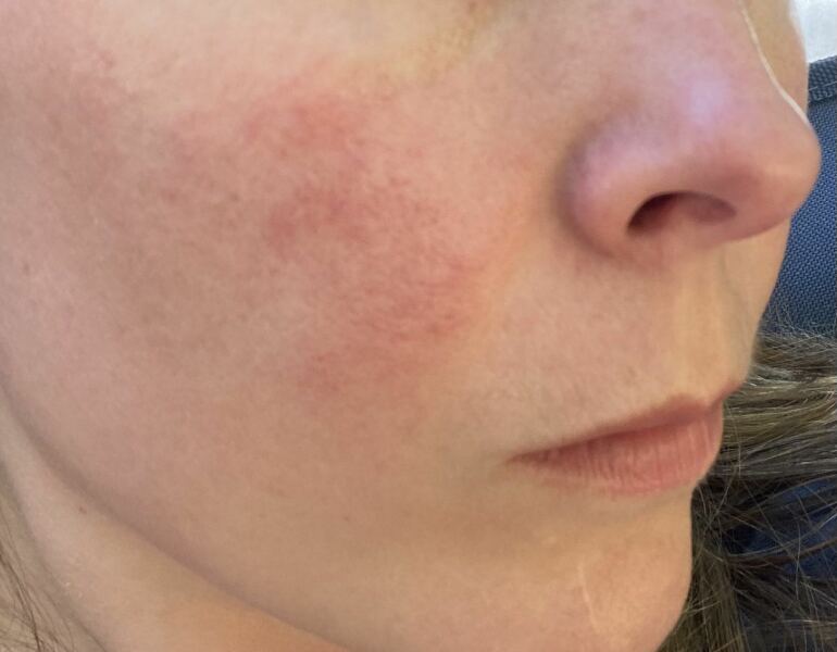Skincare help - rosacea (?) treatments. Pic included