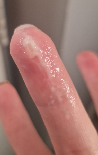 TMI CM Photos 4/5DPO