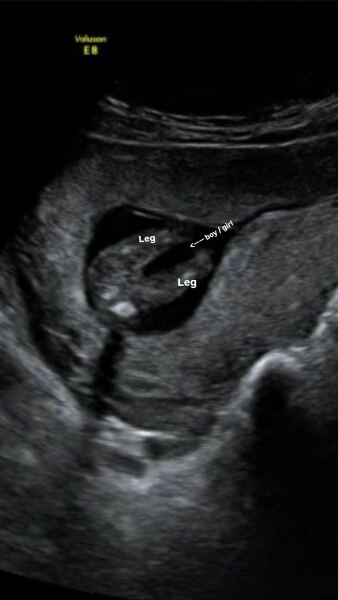 To think the sonographer could be wrong?