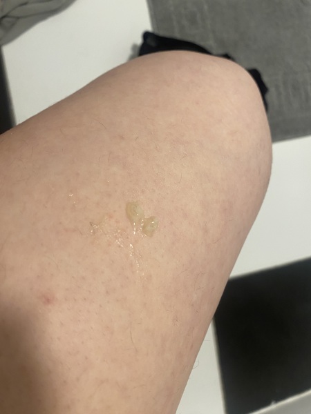 Mucus plug
