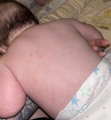 Red Marks on baby back