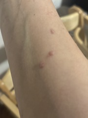 Rash