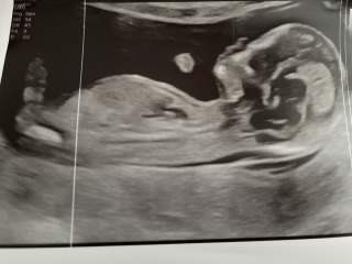 13+3 week scan… Any gender guesses?? :)