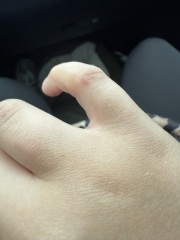 Small dog bite- worried AIBU