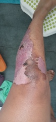 2nd degree burns from boiling water