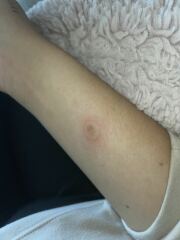 Can anyone help - is this pityriasis rosea??