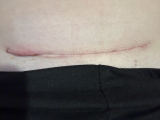 Is my c section wound infected?