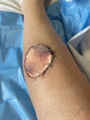 Cancer wound