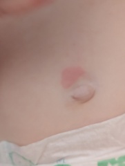 Hives ??? Advice please