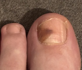 Subungual melanoma?