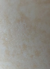 What are these shiny round patches on my hands and forearms?