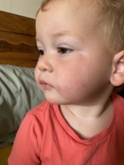 Is this slapped cheek?