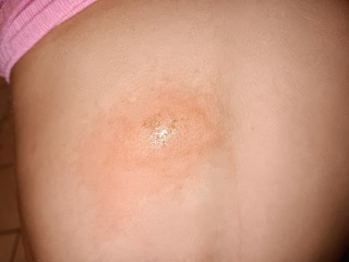 What is this on my daughters back?