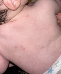 Red Marks on baby back