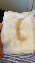 TMI pics! Mucus plug or bloody show?