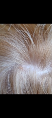 Spots on scalp