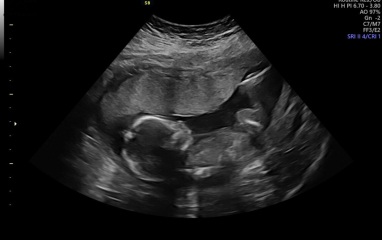 3d scan at 17 weeks 🥹🤍