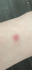 Mole or re lump