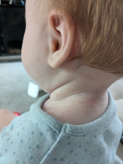 Purple rash on babies neck and back