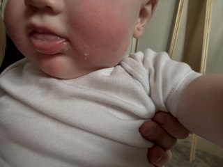 Baby rash on face