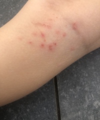 Rash? Or other