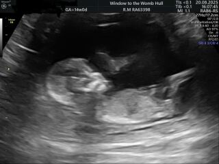 Sex of Baby before Scan tomorrow 🩷💙