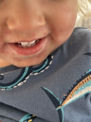 Almost 2 year old eczema around mouth