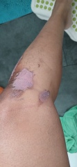 2nd degree burns from boiling water