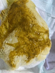 Mucus in poo