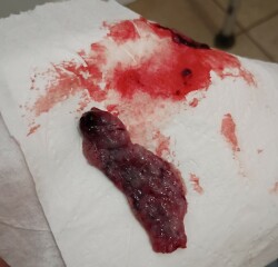 Warning: bloody pictures