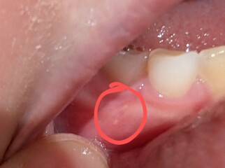Dental issues in 11 year old