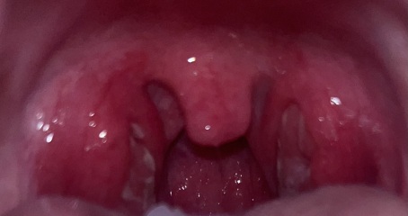 Is this tonsillitis or something else?
