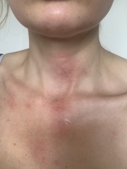HELP! Burnt neck and chest with hot oil
