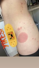 Can anyone help - is this pityriasis rosea??