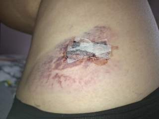 Normal after mole removal?
