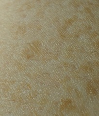 What are these shiny round patches on my hands and forearms?