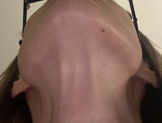 Hair removal due to pcos
