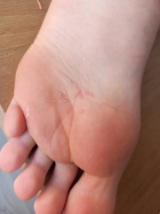 Spots on sole of foot